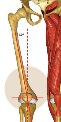 Q-Angle Training with an arthritic knee or a patellar tracking problem isn’t a deal breaker that will leave you crippled, but it does mean you should be cautious. These conditions can cause further injuries or simply become worse, making training more painful and less than desirable to keep doing. Management for both conditions includes stretching and strengthening exercises to keep the muscles in the knee balanced. Physiotherapy modalities including ultrasound, cold laser and Kinesio taping are also good options to keep pain under control. Cross training, bicycling and general lower body strengthening is always a good idea.